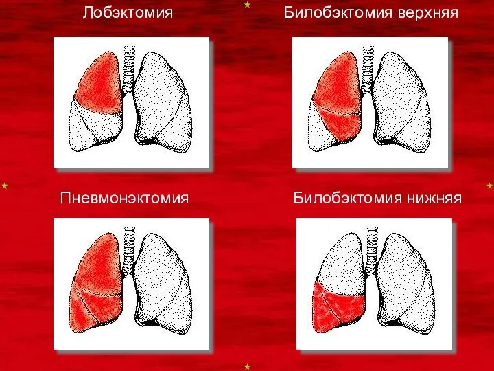 Билобэктомия верхняя Билобэктомия нижняя Лобэктомия Пневмонэктомия