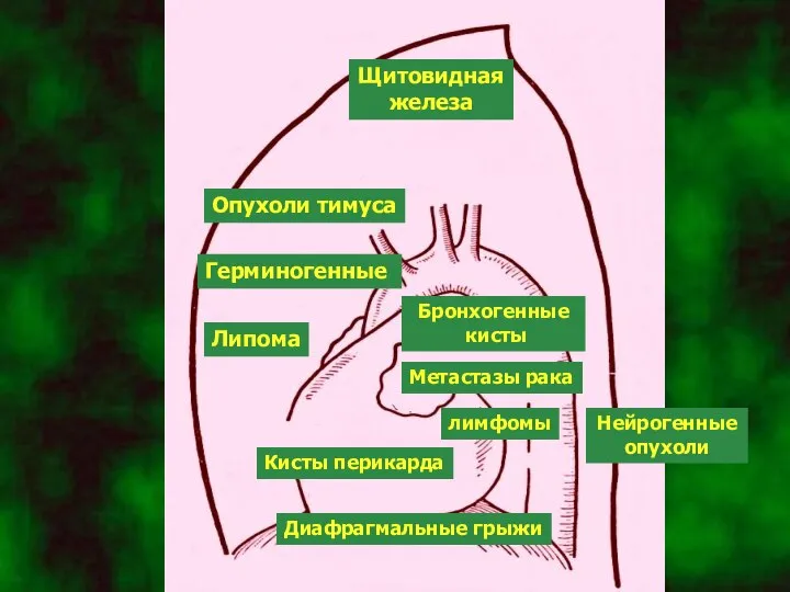 Опухоли тимуса Щитовидная железа Герминогенные Липома Бронхогенные кисты Метастазы рака лимфомы