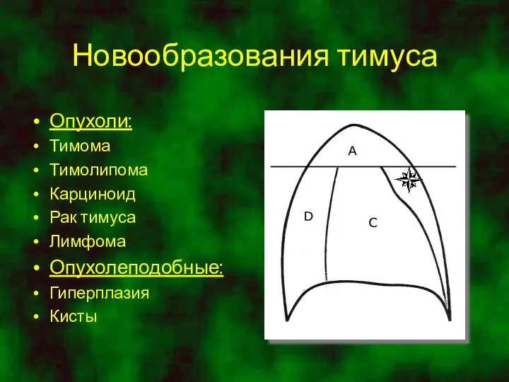 Новообразования тимуса Опухоли: Тимома Тимолипома Карциноид Рак тимуса Лимфома Опухолеподобные: Гиперплазия Кисты