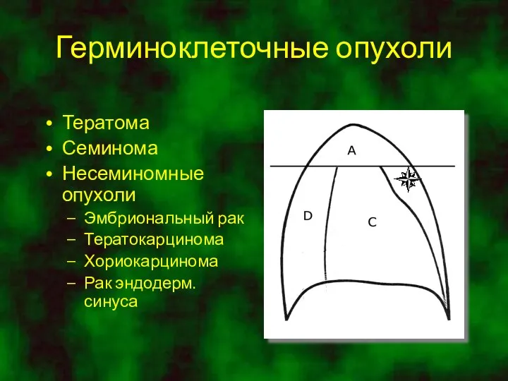 Герминоклеточные опухоли Тератома Семинома Несеминомные опухоли Эмбриональный рак Тератокарцинома Хориокарцинома Рак эндодерм.синуса