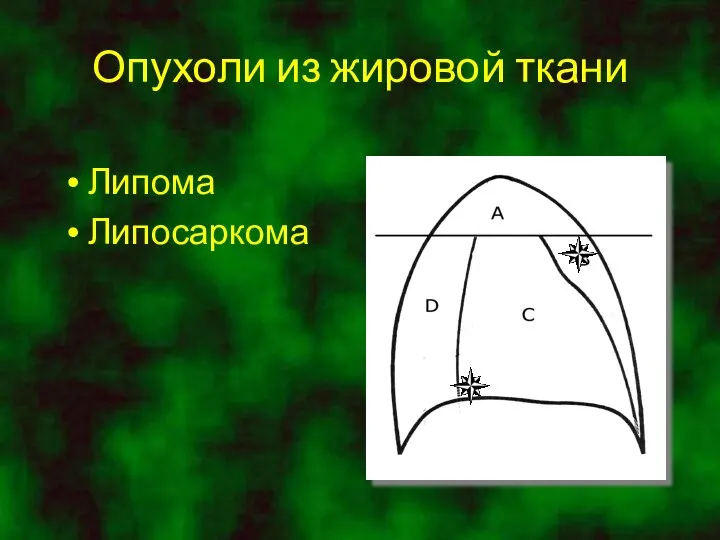 Опухоли из жировой ткани Липома Липосаркома