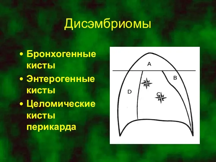 Дисэмбриомы Бронхогенные кисты Энтерогенные кисты Целомические кисты перикарда