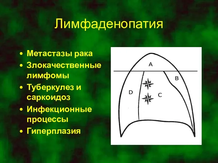 Лимфаденопатия Метастазы рака Злокачественные лимфомы Туберкулез и саркоидоз Инфекционные процессы Гиперплазия