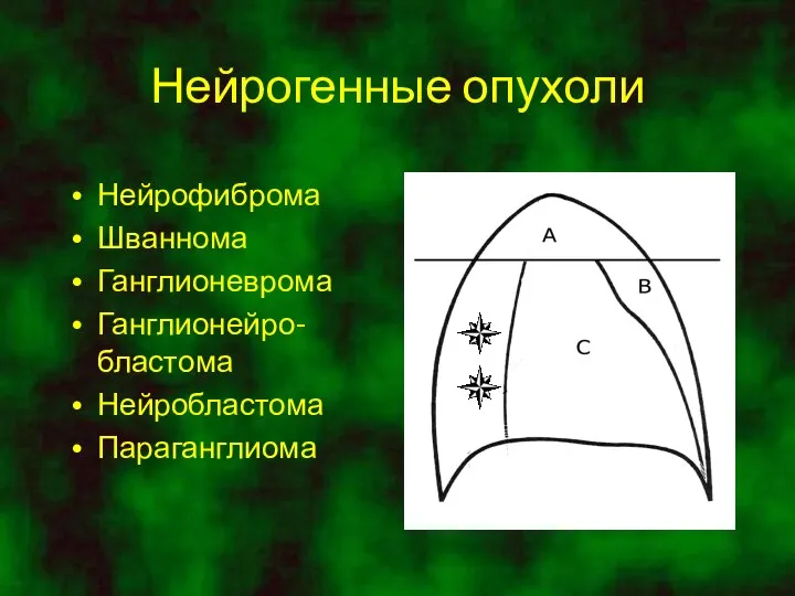 Нейрогенные опухоли Нейрофиброма Шваннома Ганглионеврома Ганглионейро-бластома Нейробластома Параганглиома