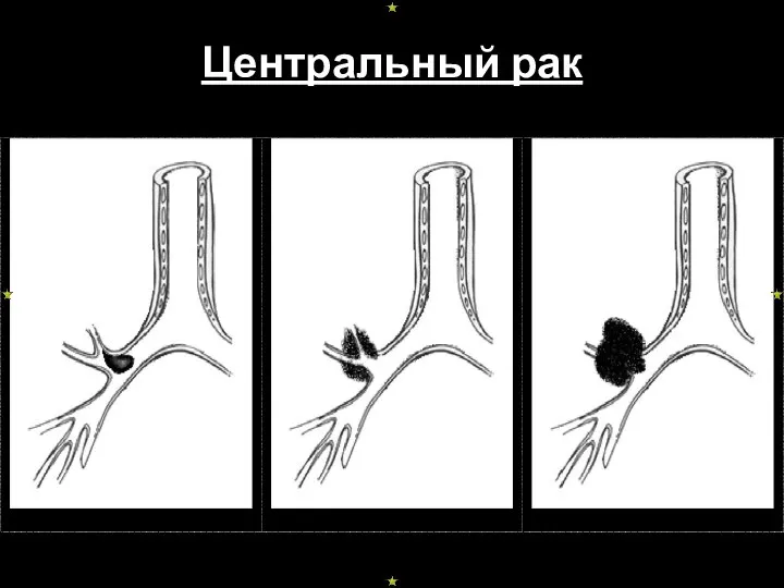 Центральный рак