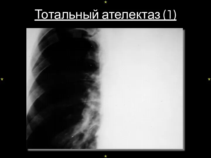 Тотальный ателектаз (1)