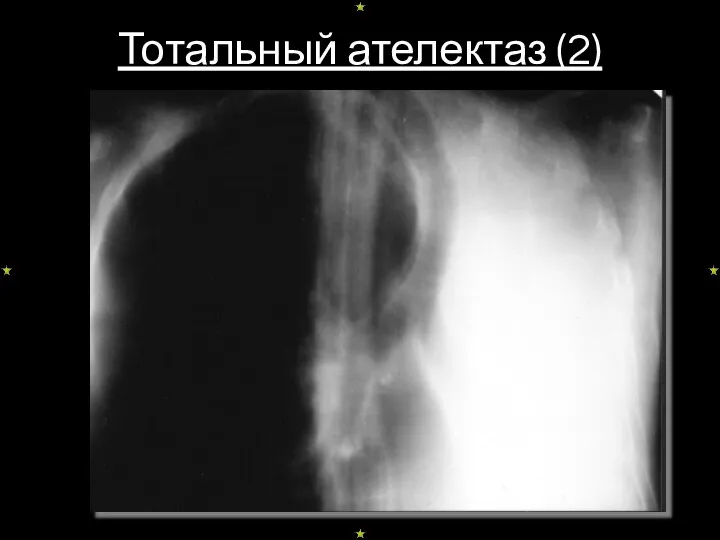 Тотальный ателектаз (2)