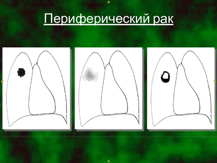 Периферический рак