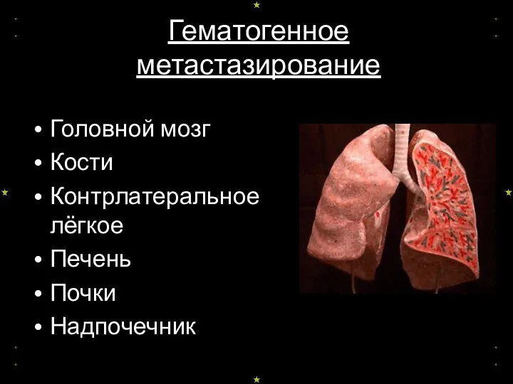 Гематогенное метастазирование Головной мозг Кости Контрлатеральное лёгкое Печень Почки Надпочечник