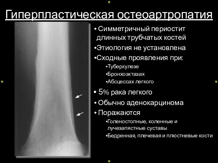 Гиперпластическая остеоартропатия Симметричный периостит длинных трубчатых костей Этиология не установлена Сходные