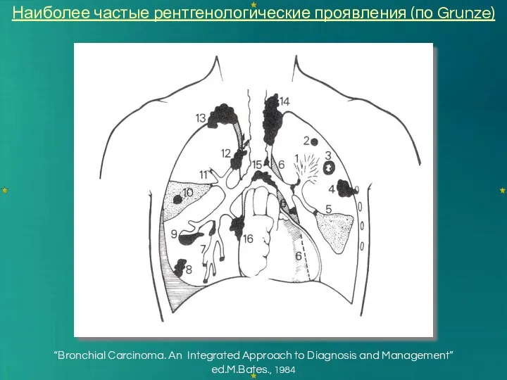 “Bronchial Carcinoma. An Integrated Approach to Diagnosis and Management” ed.M.Bates., 1984