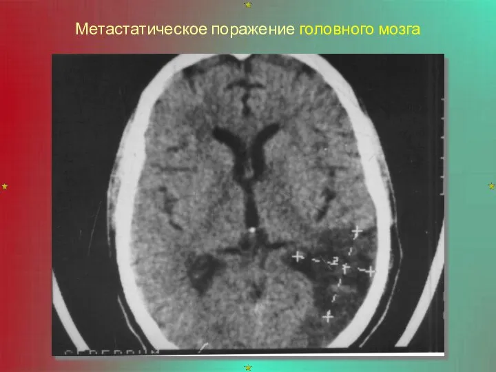 Метастатическое поражение головного мозга