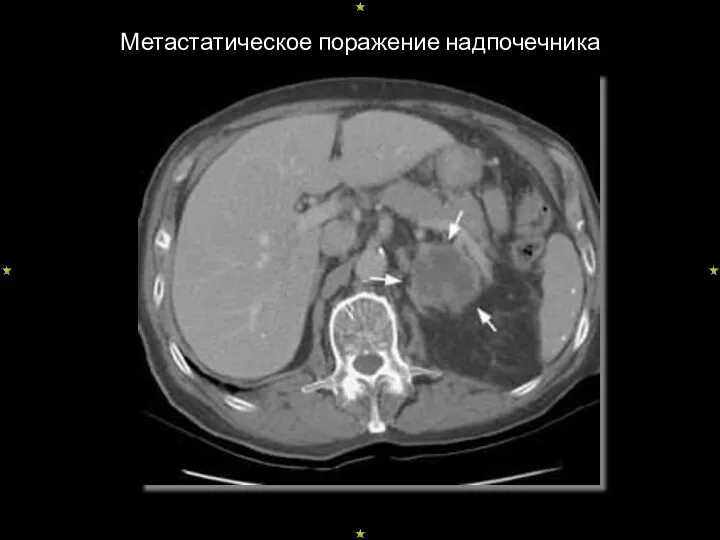 Метастатическое поражение надпочечника