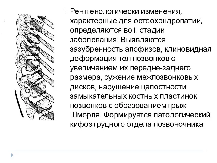 Рентгенологически изменения, характерные для остеохондропатии, определяются во II стадии заболевания. Выявляются