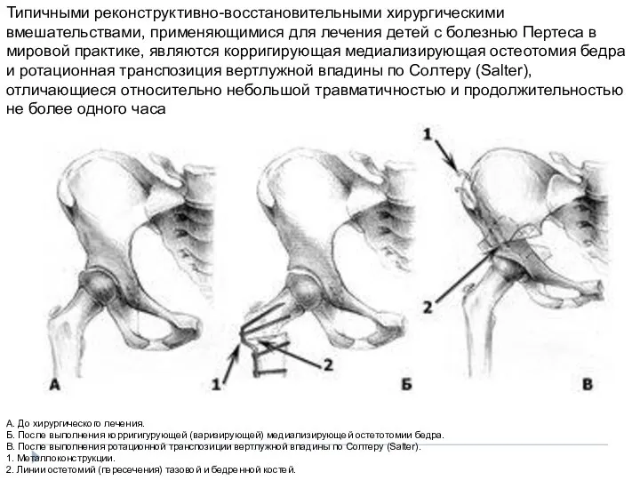 Типичными реконструктивно-восстановительными хирургическими вмешательствами, применяющимися для лечения детей с болезнью Пертеса