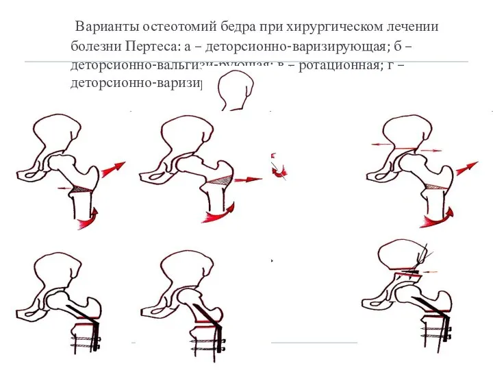 Варианты остеотомий бедра при хирургическом лечении болезни Пертеса: а – деторсионно-варизирующая;