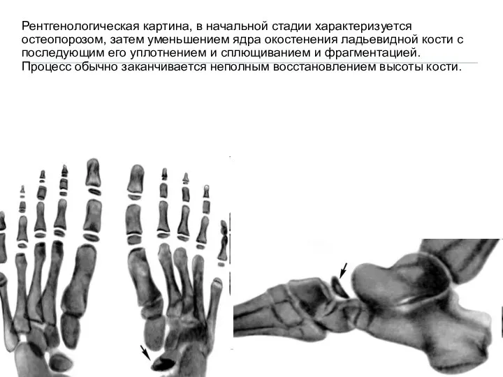 Рентгенологическая картина, в начальной стадии характеризуется остеопорозом, затем уменьшением ядра окостенения