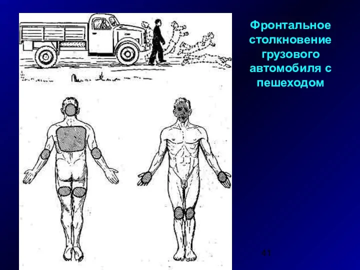 Фронтальное столкновение грузового автомобиля с пешеходом