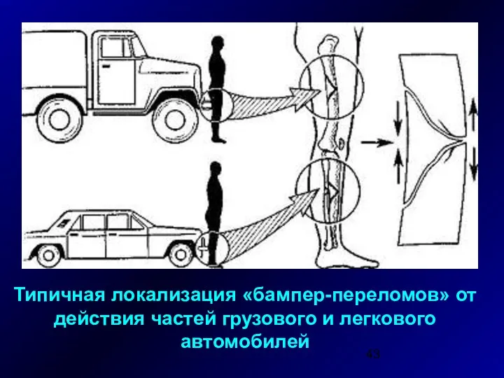 Типичная локализация «бампер-переломов» от действия частей грузового и легкового автомобилей