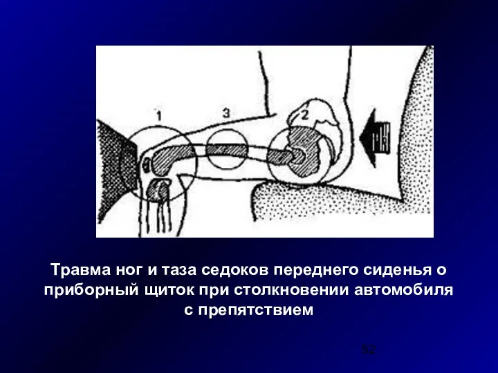 Травма ног и таза седоков переднего сиденья о приборный щиток при столкновении автомобиля с препятствием