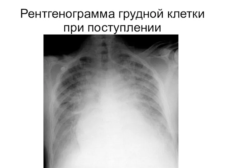 Рентгенограмма грудной клетки при поступлении