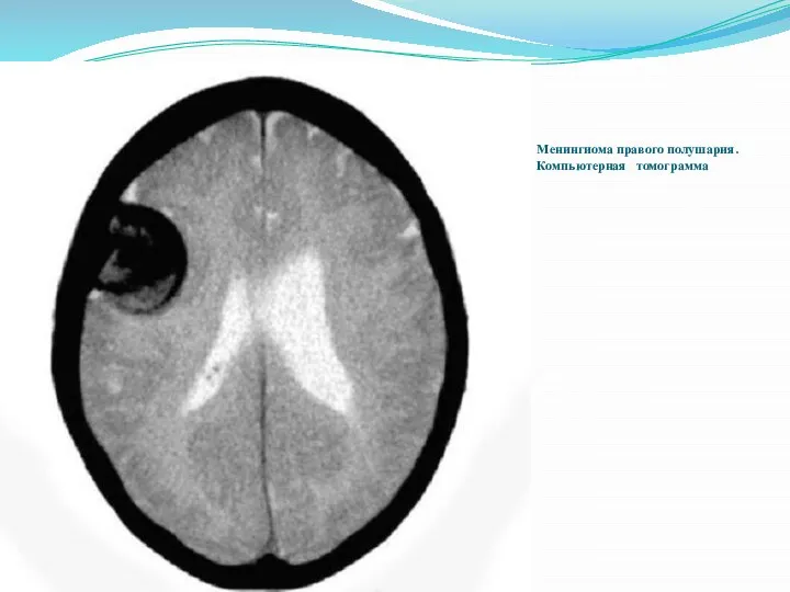 Менингиома правого полушария. Компьютерная томограмма