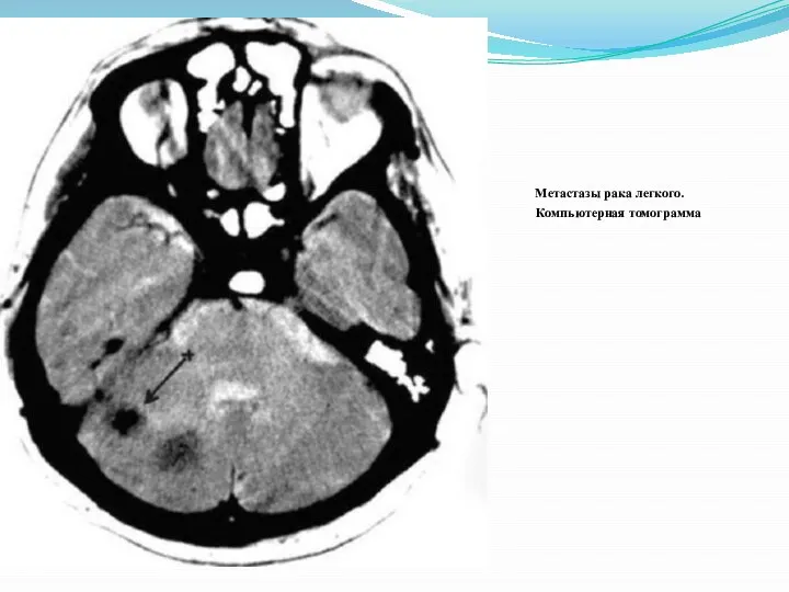 Метастазы рака легкого. Кииииииииииииииииииииииииииииииииииииииииииииииииииии Компьютерная томограмма