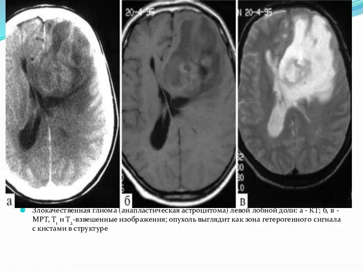 Злокачественная глиома (анапластическая астроцитома) левой лобной доли: а - КТ; б,