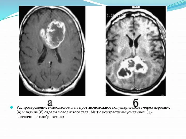 Распространение глиобластомы на противоположное полушарие мозга через передние (а) и задние