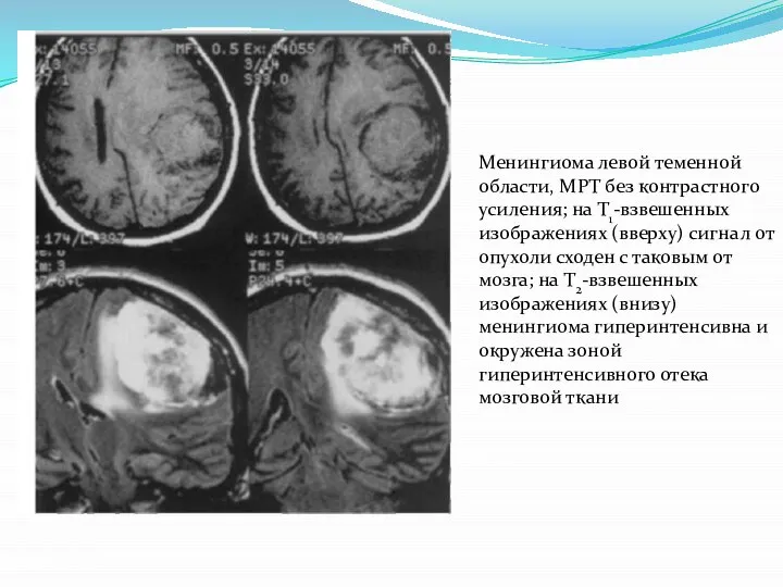 Менингиома левой теменной области, МРТ без контрастного усиления; на Т1-взвешенных изображениях