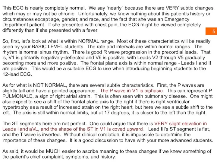 This ECG is nearly completely normal. We say "nearly" because there