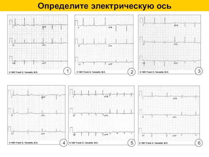 Определите электрическую ось 1 2 3 4 5 3 6