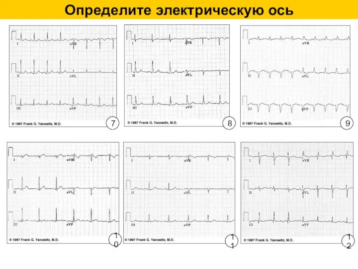 Определите электрическую ось 7 8 9 10 11 12