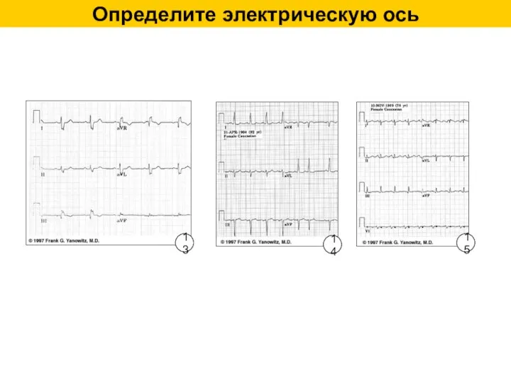 Определите электрическую ось 13 14 15