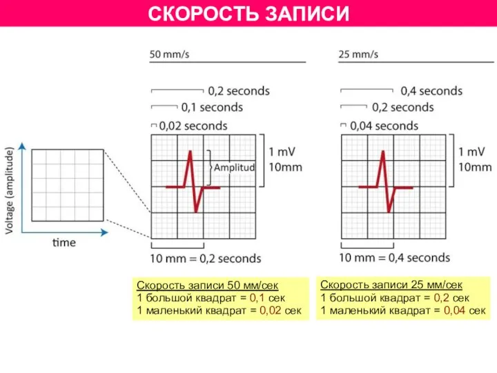 СКОРОСТЬ ЗАПИСИ Скорость записи 25 мм/сек 1 большой квадрат = 0,2