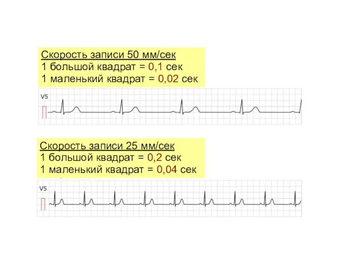 Скорость записи 50 мм/сек 1 большой квадрат = 0,1 сек 1