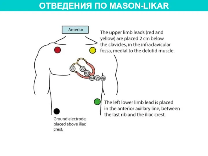 ОТВЕДЕНИЯ ПО MASON-LIKAR