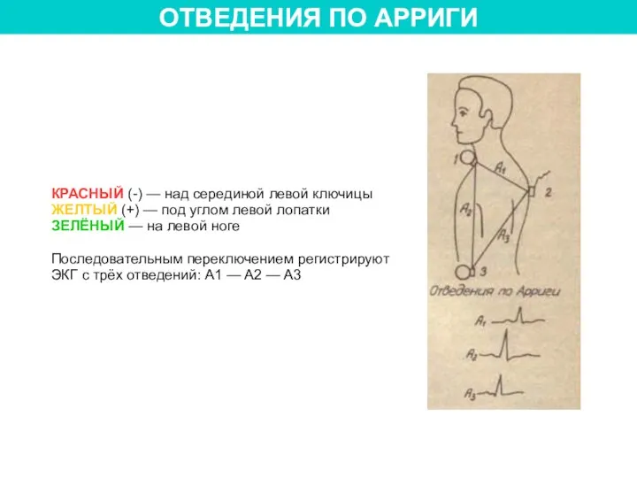 ОТВЕДЕНИЯ ПО АРРИГИ КРАСНЫЙ (-) — над серединой левой ключицы ЖЕЛТЫЙ