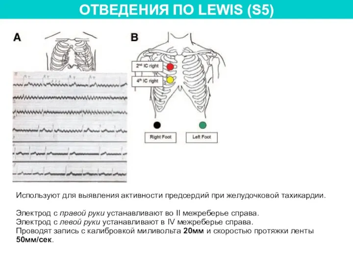 ОТВЕДЕНИЯ ПО LEWIS (S5) Используют для выявления активности предсердий при желудочковой