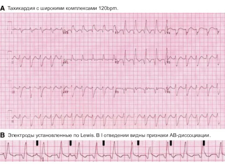 Тахикардия с широкими комплексами 120bpm. Электроды установленные по Lewis. В I отведении видны признаки АВ-диссоциации.