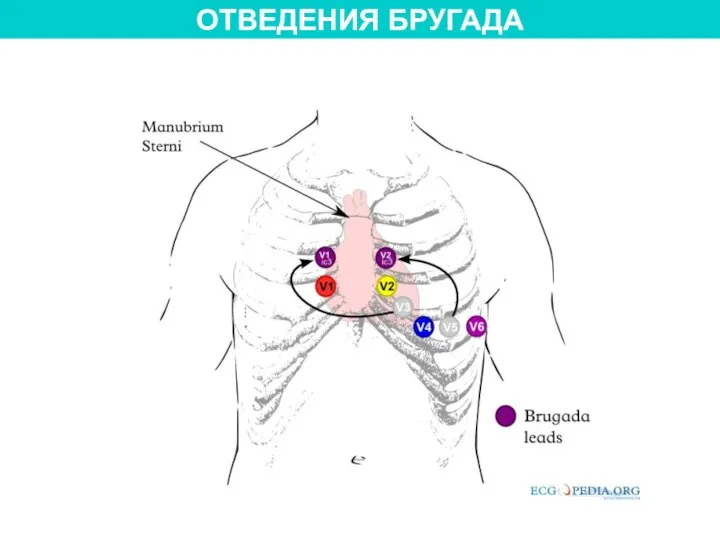 ОТВЕДЕНИЯ БРУГАДА