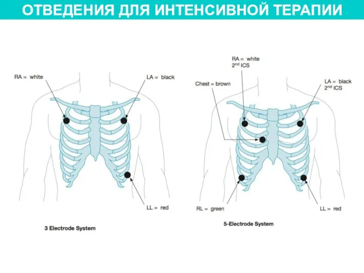 ОТВЕДЕНИЯ ДЛЯ ИНТЕНСИВНОЙ ТЕРАПИИ