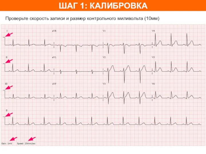 ШАГ 1: КАЛИБРОВКА Проверьте скорость записи и размер контрольного миливольта (10мм)