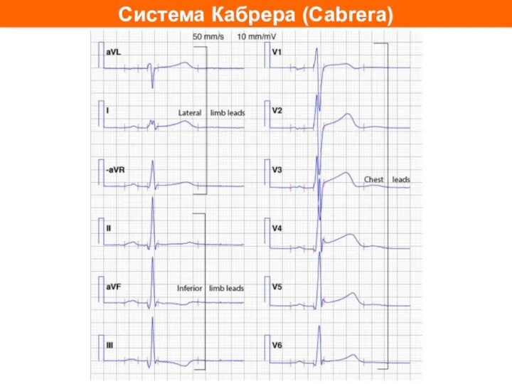 Система Кабрера (Cabrera)