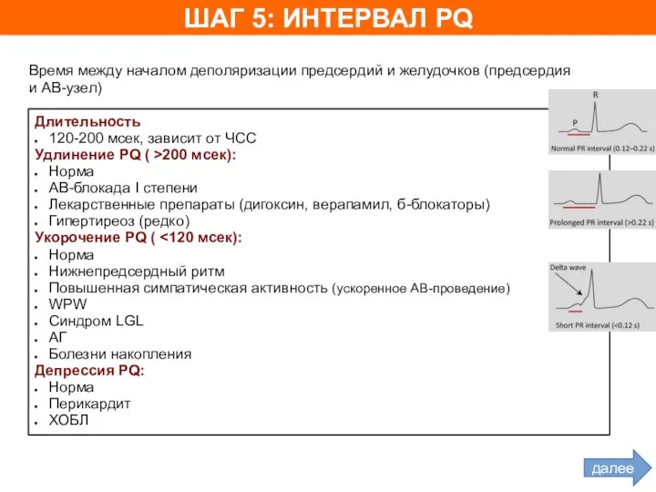 ШАГ 5: ИНТЕРВАЛ PQ Длительность 120-200 мсек, зависит от ЧСС Удлинение