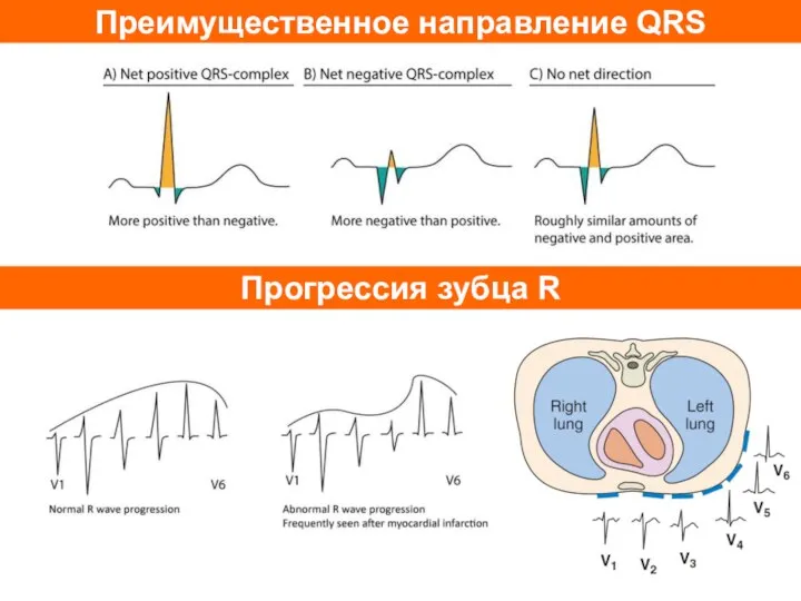 Преимущественное направление QRS Прогрессия зубца R