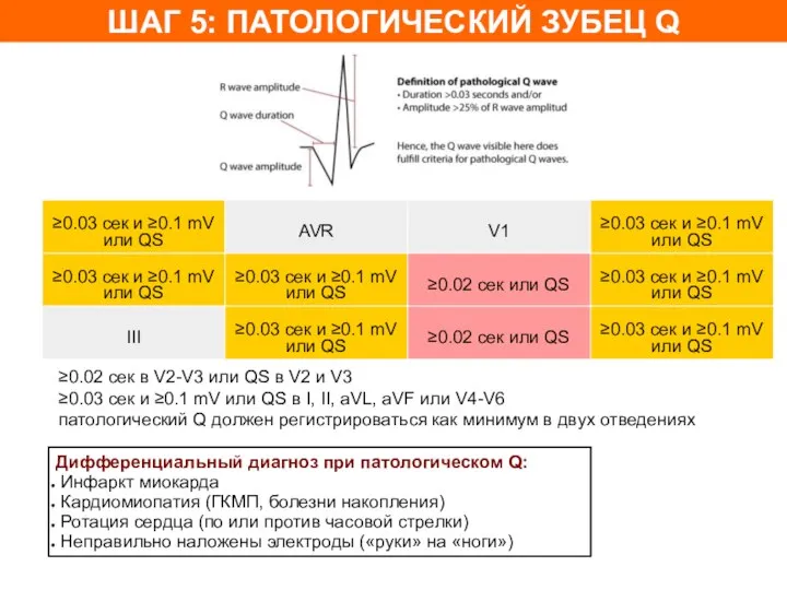 ШАГ 5: ПАТОЛОГИЧЕСКИЙ ЗУБЕЦ Q ≥0.02 сек в V2-V3 или QS