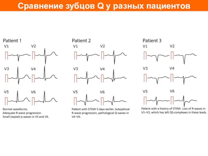 Сравнение зубцов Q у разных пациентов