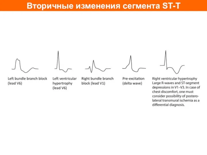 Вторичные изменения сегмента ST-T