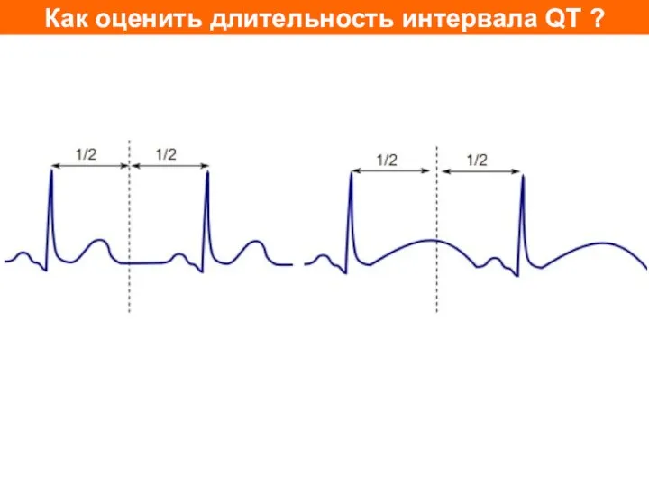 Как оценить длительность интервала QT ?